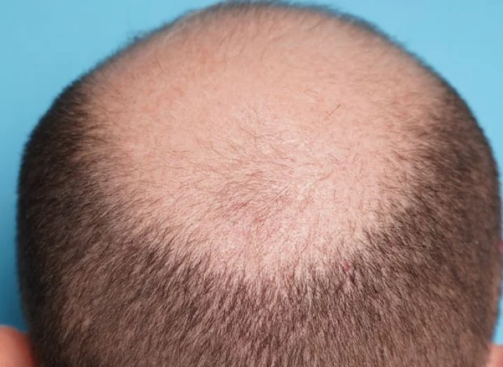 गंजे सिर पर बाल उगाने का दावा कर के इंदौर के लोगों को चूना लगा गया सलमान, ऐसे आया पकड़ में