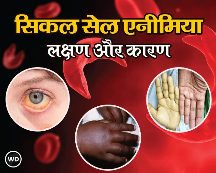 सिकल सेल एनीमिया क्या है