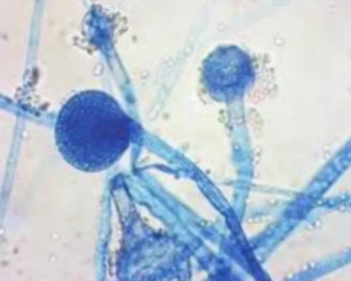 ICMR study report on mucor mycosis
