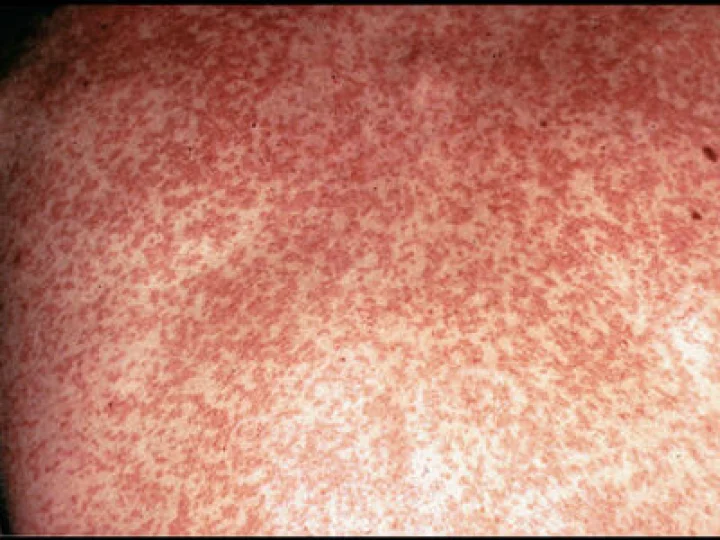 What is measles? What are the symptoms? Measles is an infectious disease Measles symptoms goverchi lakshane symptom of rubella disease  Measles? information aboutmeasles gover