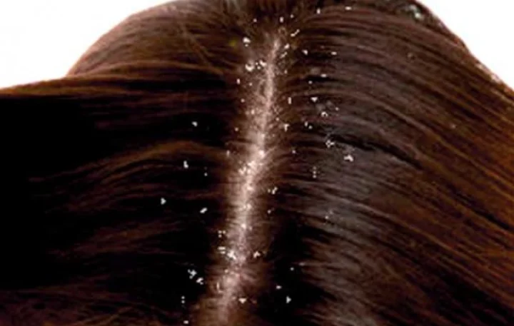 ತಲೆಹೊಟ್ಟು