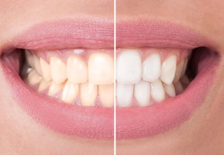 What to do if teeth turn yellow
