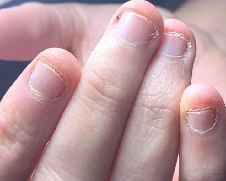 Nail biting
