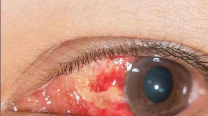 नाशिकला डोळ्यांच्या रुग्णांत सातत्याने वाढ; शहरात 300 डोळ्यांचे रुग्ण