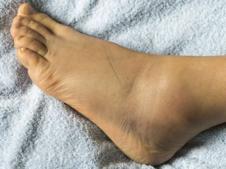 Why do feet swell during pregnancy? Learn how to get relief from it