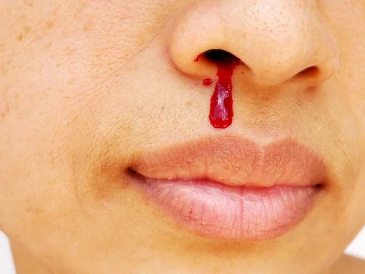 Hemophilia B