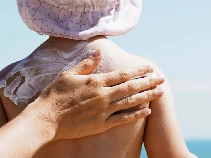 Sunburn Home remedies