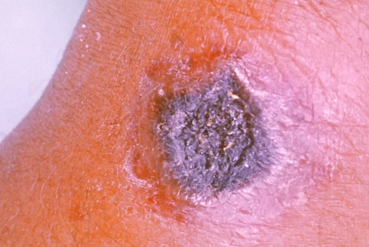 What is Anthrax എന്താണ് ആന്ത്രാക്‌സ്? മനുഷ്യര്‍ പേടിക്കണോ?