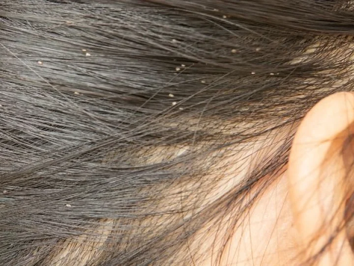 Hair Care Tips head lice  try these home remedies   home remedies  for Head lice