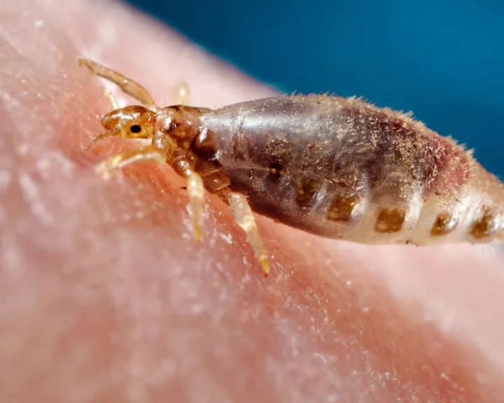 What causes lice in hair?