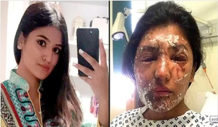 acid attack victim