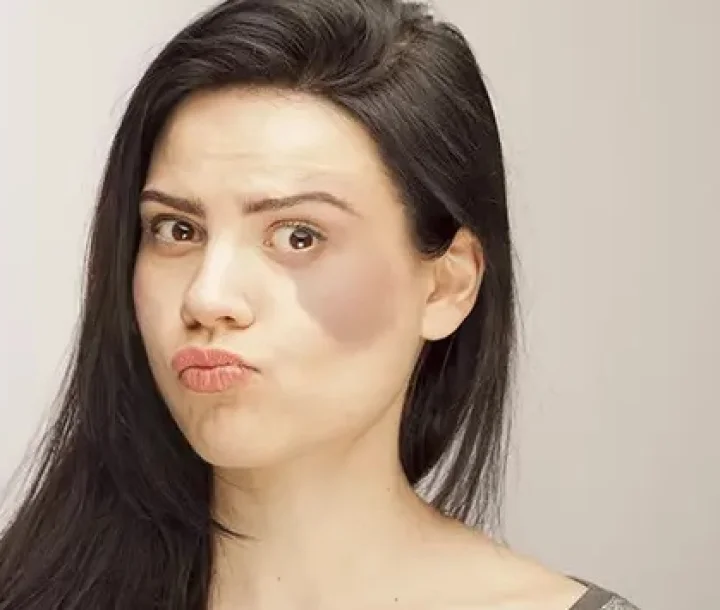 birth mark