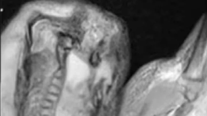 धक्कादायक ! चिमुकलीच्या मेंदूत आढळले भ्रूण