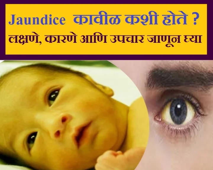 Jaundice
