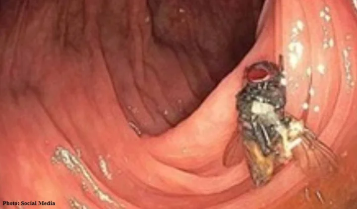 Living Fly in Man Intestines