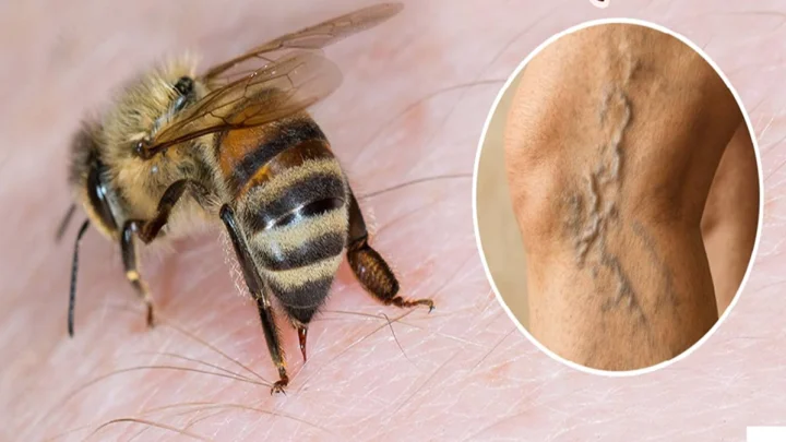 varicose veins treatment in marathi 