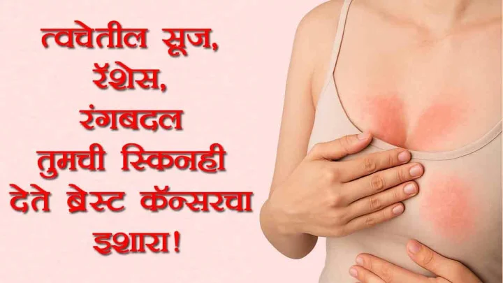 त्वचेतील सूज, रॅशेस, रंगबदल ? सावधान- त्वचा देते ब्रेस्ट कॅन्सरची पहिली सूचना