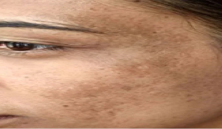 Dark spots on skin