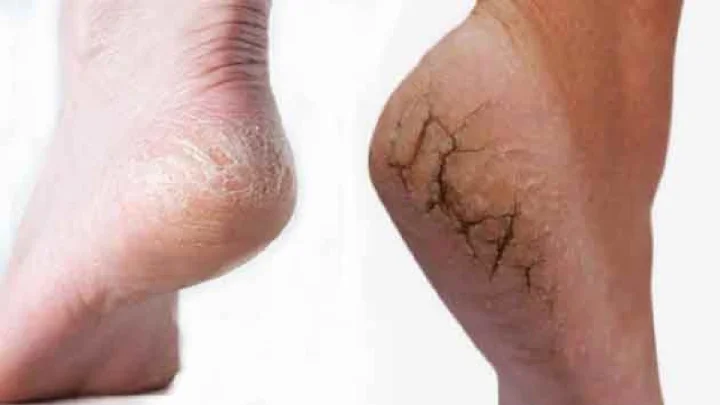 Remedies to get rid of cracked heels