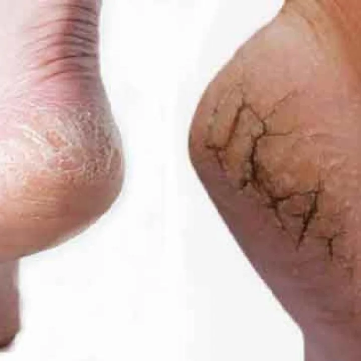 Remedies to get rid of cracked heels