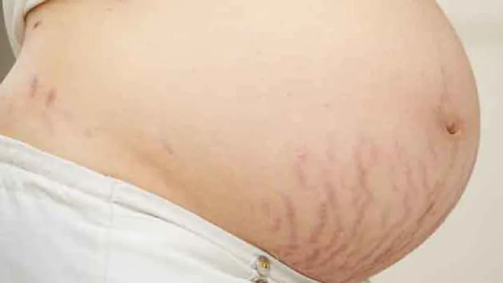 stretch mark
