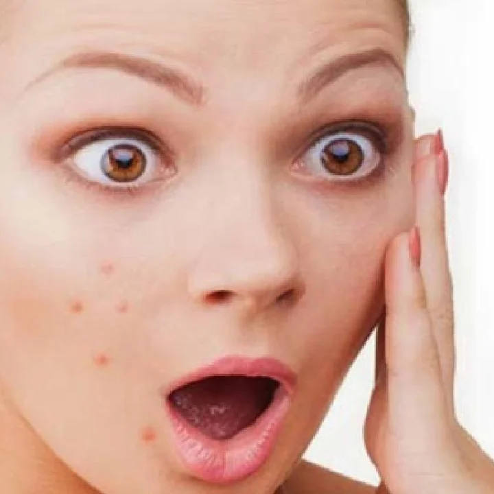 Acne Reduction Tips
