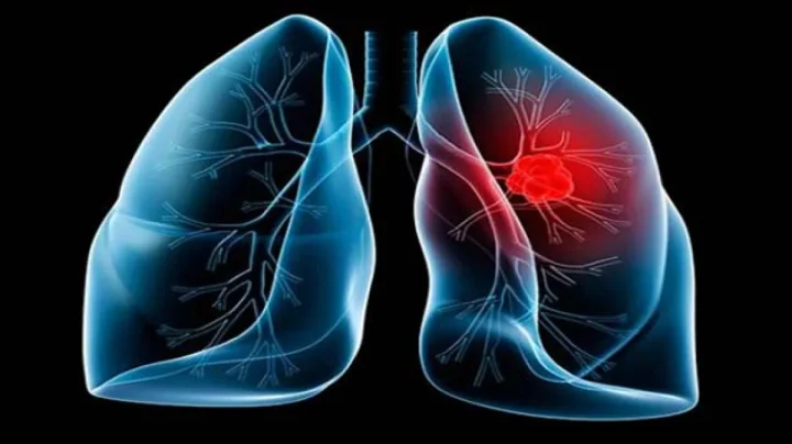 Lung Cancer सतत खोकला म्हणजे साधा त्रास नाही? सुरुवातीची ही लक्षणे दिसत नाहीत म्हणून होतो उशीर; वेळीच निदान का गरजेचे?