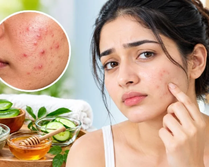 Acne Skin Care