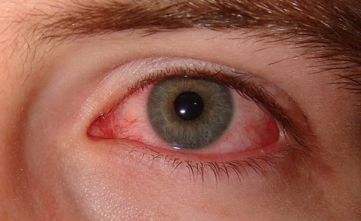 Eye infection
