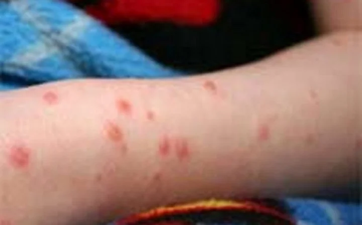 Chickenpox