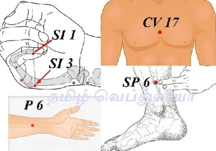 Acupuncture Treatment