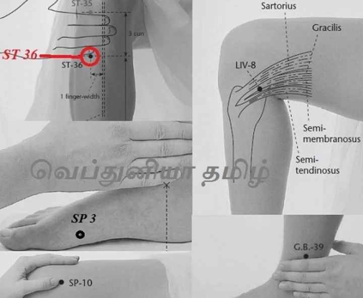 இரத்த சோகைக்கு (Anemia) அக்குபஞ்சரில் தீர்வு!