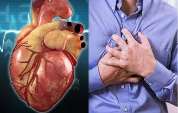 மாரடைப்பு