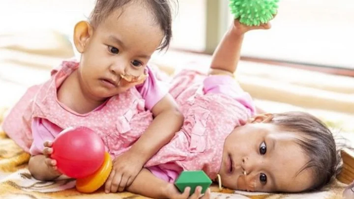 ஒட்டிப்பிறந்த இரட்டையர்களை பிரிக்க முயற்சி