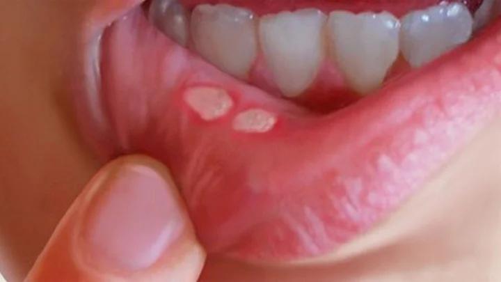 வாய்ப்புண்