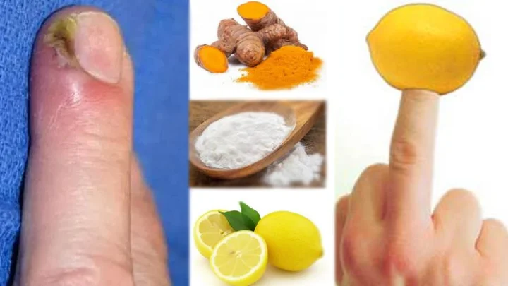 வீட்டில் இருக்கும் பொருட்களைக் கொண்டு நக சுத்தியை எளிதில் குணப்படுத்தும் வழிகள்...!