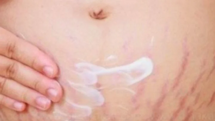Ways to Get Rid of Stretch Marks