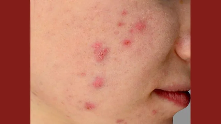 முகப்பருக்கள்