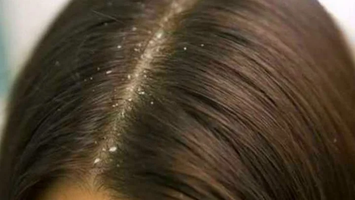 பொடுகு தொல்லை