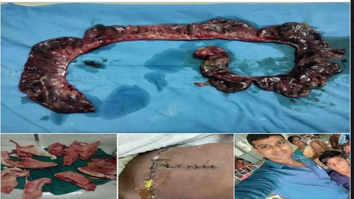 குடல் அடைப்பான் நோய்க்கு அறுவைசிகிச்சை; தொப்புள் வழியாக வெளியேறிய மலம் – சிறுவனுக்கு மறுவாழ்வு கொடுத்த அரசு மருத்துவர்கள் !
