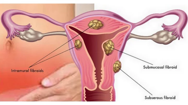 கருப்பை பாதுகாப்பு