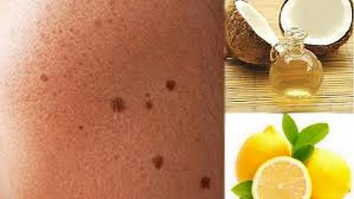 கரும்புள்ளிகள்