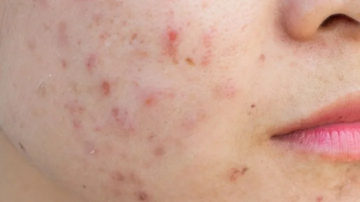 முகப்பரு தழும்புகளை நீக்க உதவும் வெந்தயம் !!