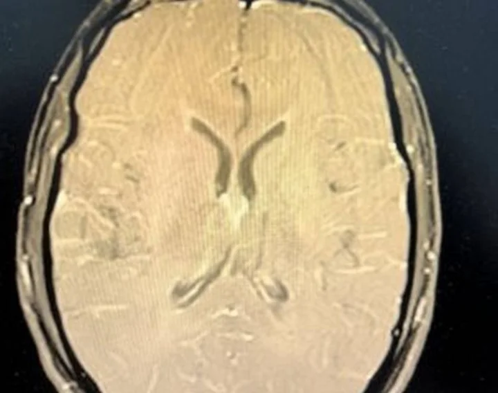 Rare Brain Complication of Sjogren-s Syndrome