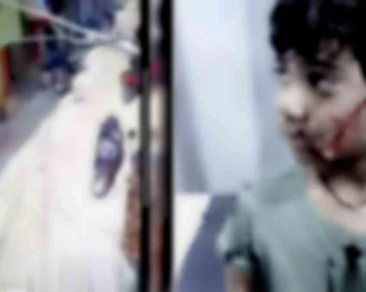 ఐదేళ్ల బాలికపై వీధికుక్క దాడి.. చెంపపై కరిచింది..