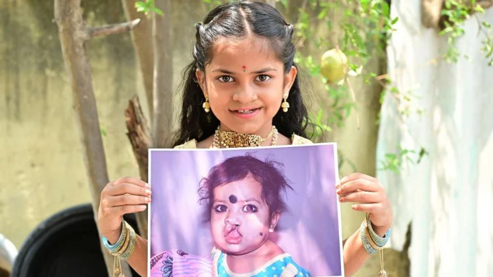 క్లెఫ్ట్స్- గ్రహణం మొర్రి ముందస్తు నిర్ధారణ కోసం అవగాహనకు స్మైల్ ట్రైన్ ఇండియా కృషి